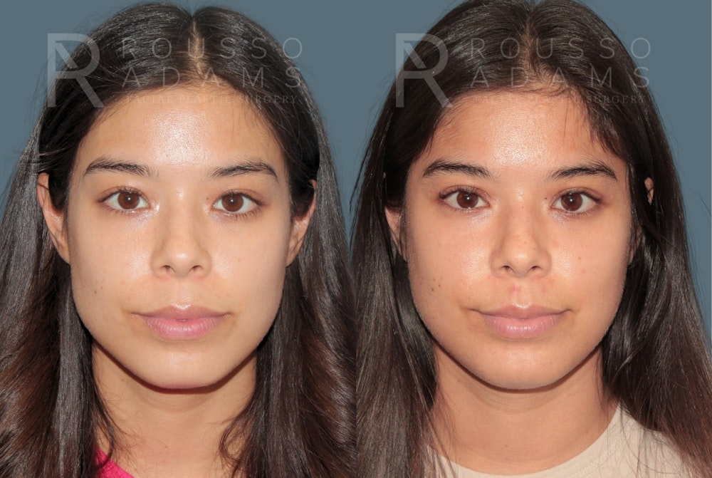 Blepharoplasty <span class=small>By Dr. Daniel Rousso</span> Before & After Gallery - Patient 226308 - Image 3