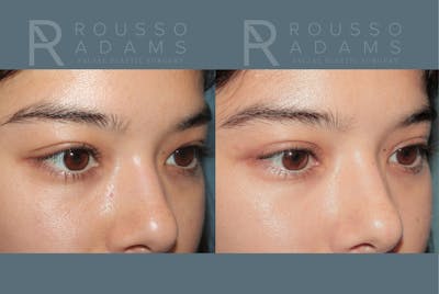 Blepharoplasty <span class=small>By Dr. Daniel Rousso</span> Before & After Gallery - Patient 226308 - Image 2