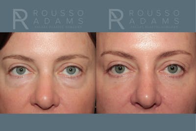 Blepharoplasty <span class=small>By Dr. Daniel Rousso</span> Before & After Gallery - Patient 431310 - Image 1