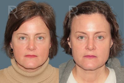 Blepharoplasty <span class=small>By Dr. Daniel Rousso</span> Before & After Gallery - Patient 431310 - Image 4