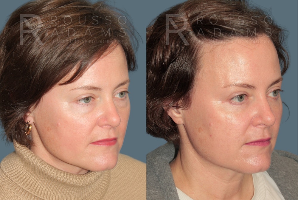 Blepharoplasty <span class=small>By Dr. Daniel Rousso</span> Before & After Gallery - Patient 431310 - Image 3