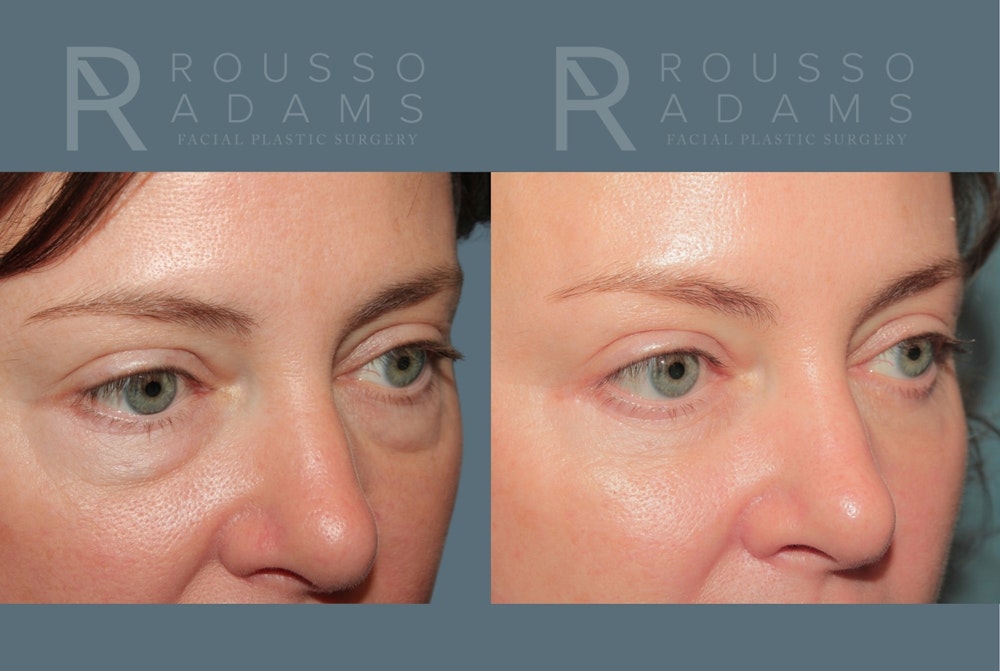 Blepharoplasty <span class=small>By Dr. Daniel Rousso</span> Before & After Gallery - Patient 431310 - Image 2