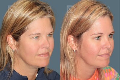 Blepharoplasty <span class=small>By Dr. Daniel Rousso</span> Before & After Gallery - Patient 360844 - Image 2