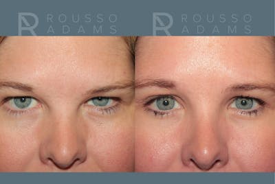 Blepharoplasty <span class=small>By Dr. Daniel Rousso</span> Before & After Gallery - Patient 360844 - Image 1