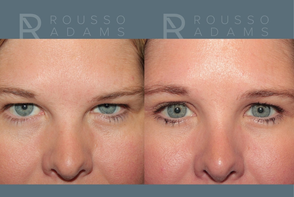 Blepharoplasty <span class=small>By Dr. Daniel Rousso</span> Before & After Gallery - Patient 360844 - Image 1