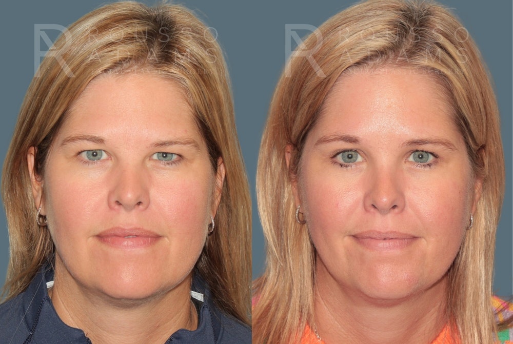 Blepharoplasty <span class=small>By Dr. Daniel Rousso</span> Before & After Gallery - Patient 360844 - Image 3