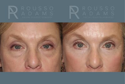 Blepharoplasty <span class=small>By Dr. Daniel Rousso</span> Before & After Gallery - Patient 215648 - Image 1