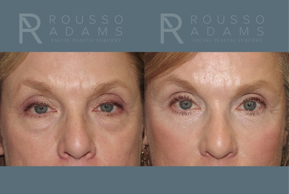 SculptLift™ <span class=small>By Dr. Daniel Rousso</span> Before & After Gallery - Patient 150207 - Image 5