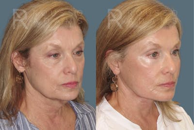SculptLift™ <span class=small>By Dr. Daniel Rousso</span> Before & After Gallery - Patient 150207 - Image 1
