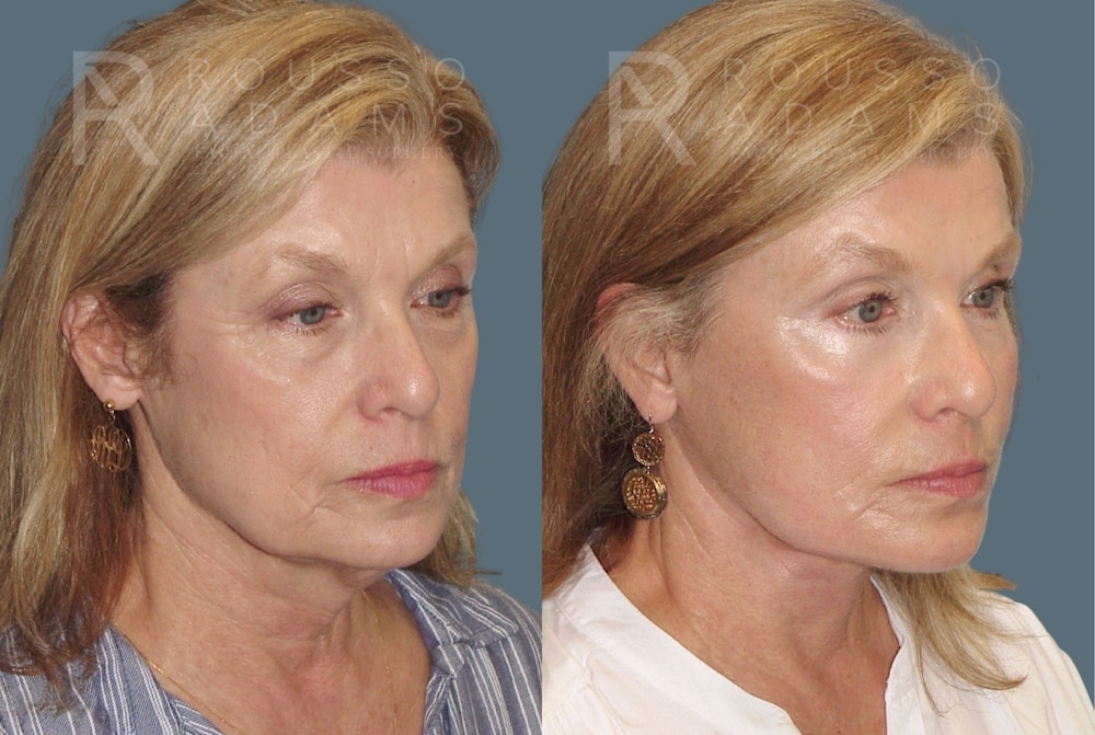 SculptLift™ <span class=small>By Dr. Daniel Rousso</span> Before & After Gallery - Patient 150207 - Image 1