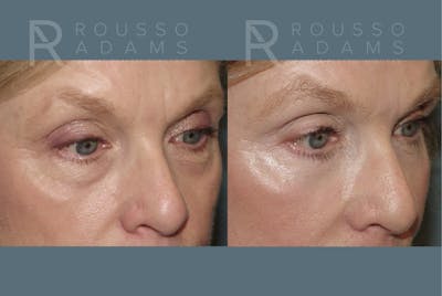 SculptLift™ <span class=small>By Dr. Daniel Rousso</span> Before & After Gallery - Patient 150207 - Image 4