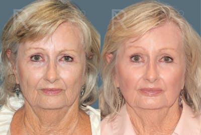 Deep Chemical Peel Gallery <span class=small>By Dr. Daniel Rousso</span> Before & After Gallery - Patient 406664 - Image 2