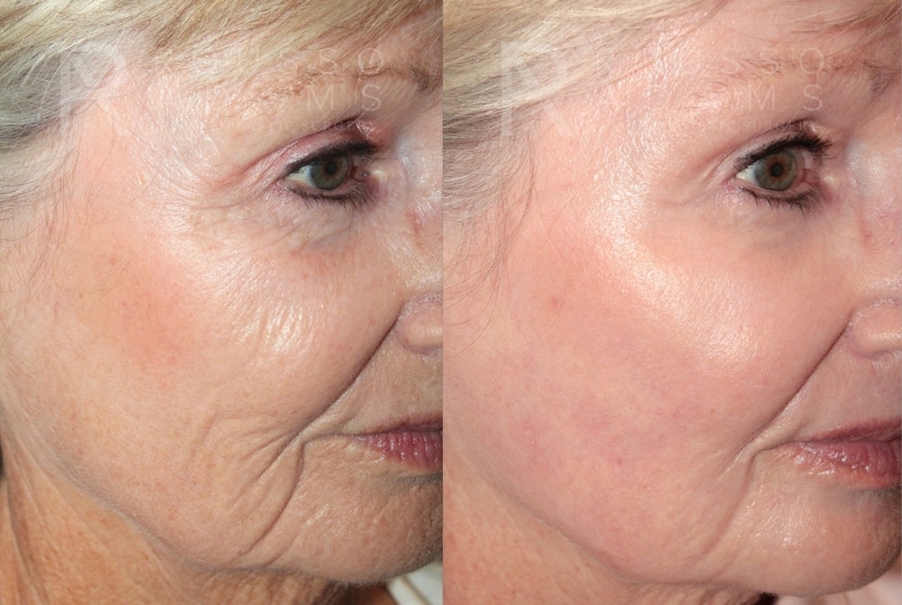 Deep Chemical Peel Gallery <span class=small>By Dr. Daniel Rousso</span> Before & After Gallery - Patient 406664 - Image 3