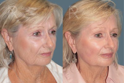 Deep Chemical Peel Gallery <span class=small>By Dr. Daniel Rousso</span> Before & After Gallery - Patient 406664 - Image 1