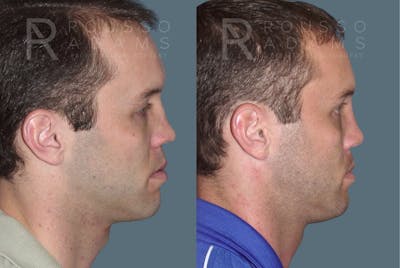 Rhinoplasty <span class=small>By Dr. Daniel Rousso</span> Before & After Gallery - Patient 215212 - Image 1