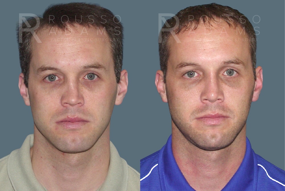 Rhinoplasty <span class=small>By Dr. Daniel Rousso</span> Before & After Gallery - Patient 215212 - Image 3