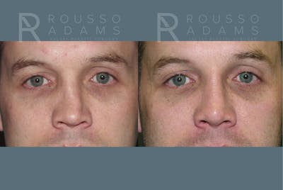 Rhinoplasty <span class=small>By Dr. Daniel Rousso</span> Before & After Gallery - Patient 215212 - Image 4