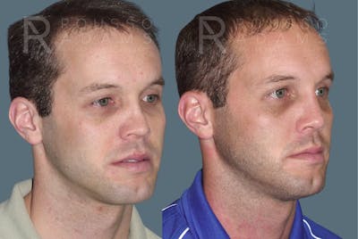 Rhinoplasty <span class=small>By Dr. Daniel Rousso</span> Before & After Gallery - Patient 215212 - Image 2