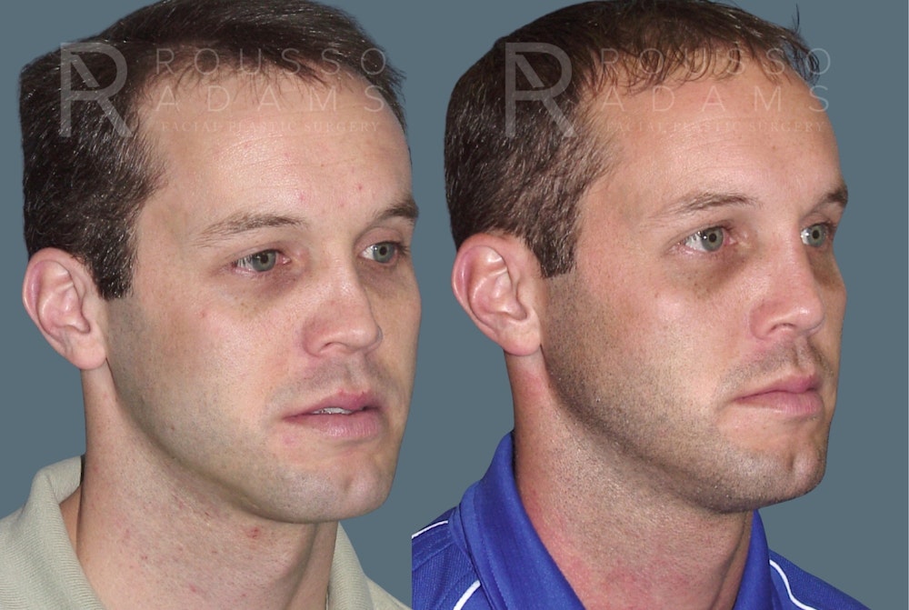 Rhinoplasty <span class=small>By Dr. Daniel Rousso</span> Before & After Gallery - Patient 215212 - Image 2