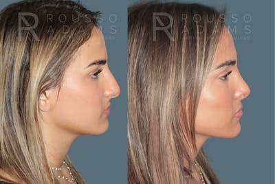 Rhinoplasty <span class=small>By Dr. Daniel Rousso</span> Before & After Gallery - Patient 181745 - Image 1
