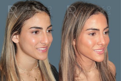 Rhinoplasty <span class=small>By Dr. Daniel Rousso</span> Before & After Gallery - Patient 181745 - Image 2