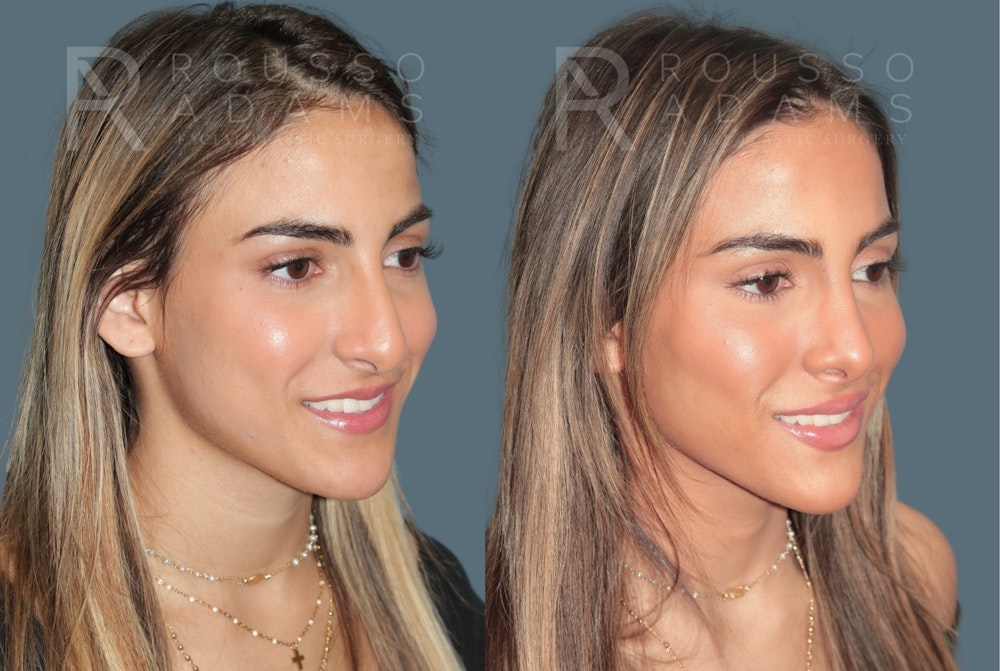 Rhinoplasty <span class=small>By Dr. Daniel Rousso</span> Before & After Gallery - Patient 181745 - Image 2
