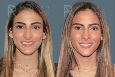 Rhinoplasty <span class=small>By Dr. Daniel Rousso</span> Before & After Gallery - Patient 181745 - Image 1