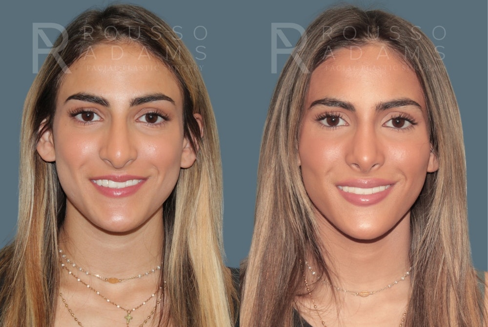 Rhinoplasty <span class=small>By Dr. Daniel Rousso</span> Before & After Gallery - Patient 181745 - Image 3