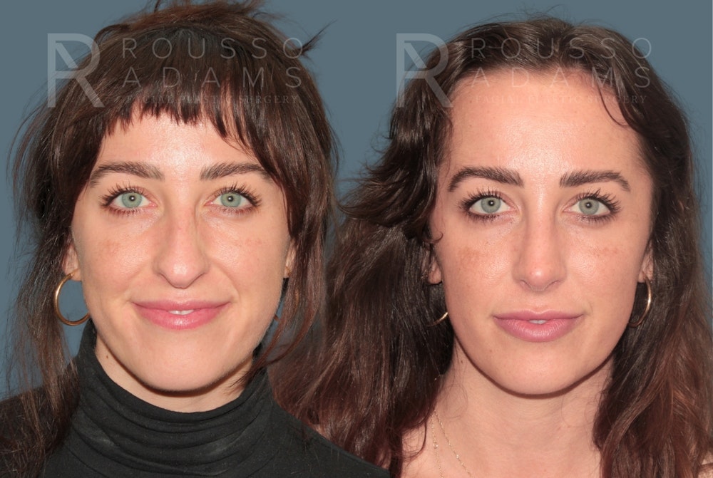 Rhinoplasty <span class=small>By Dr. Daniel Rousso</span> Before & After Gallery - Patient 327331 - Image 3