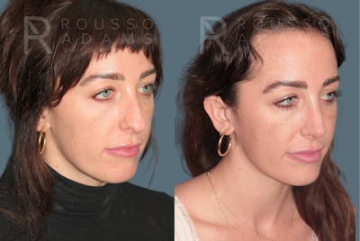 Rhinoplasty <span class=small>By Dr. Daniel Rousso</span> Before & After Gallery - Patient 327331 - Image 2