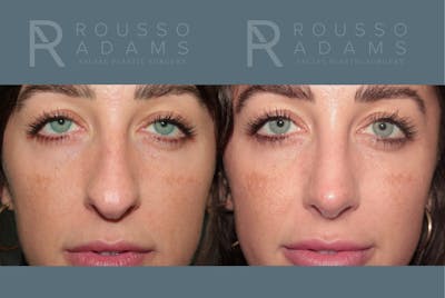Rhinoplasty <span class=small>By Dr. Daniel Rousso</span> Before & After Gallery - Patient 327331 - Image 4