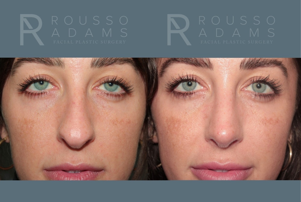 Rhinoplasty <span class=small>By Dr. Daniel Rousso</span> Before & After Gallery - Patient 327331 - Image 4