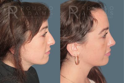 Rhinoplasty <span class=small>By Dr. Daniel Rousso</span> Before & After Gallery - Patient 327331 - Image 1