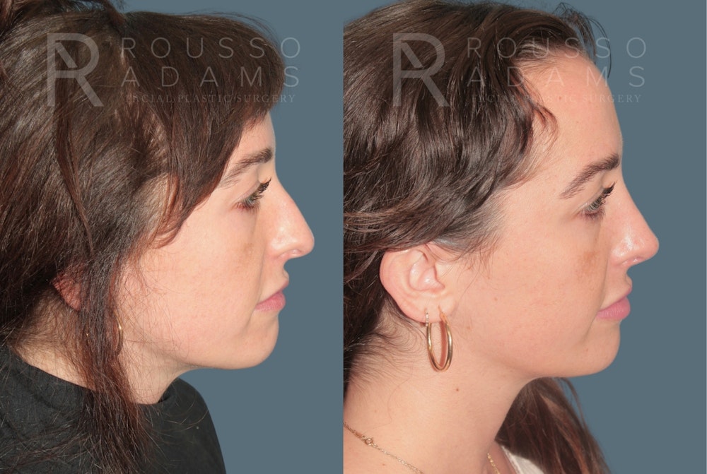 Rhinoplasty <span class=small>By Dr. Daniel Rousso</span> Before & After Gallery - Patient 327331 - Image 1