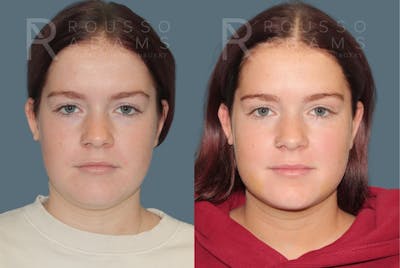 Acculift <span class=small>By Dr. Daniel Rousso</span> Before & After Gallery - Patient 336954 - Image 2
