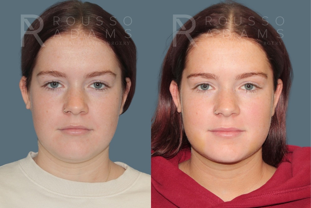 Acculift <span class=small>By Dr. Daniel Rousso</span> Before & After Gallery - Patient 336954 - Image 2