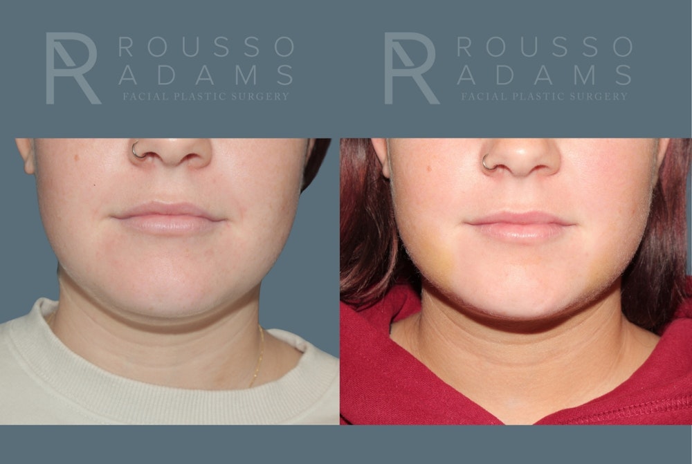 Acculift <span class=small>By Dr. Daniel Rousso</span> Before & After Gallery - Patient 336954 - Image 3