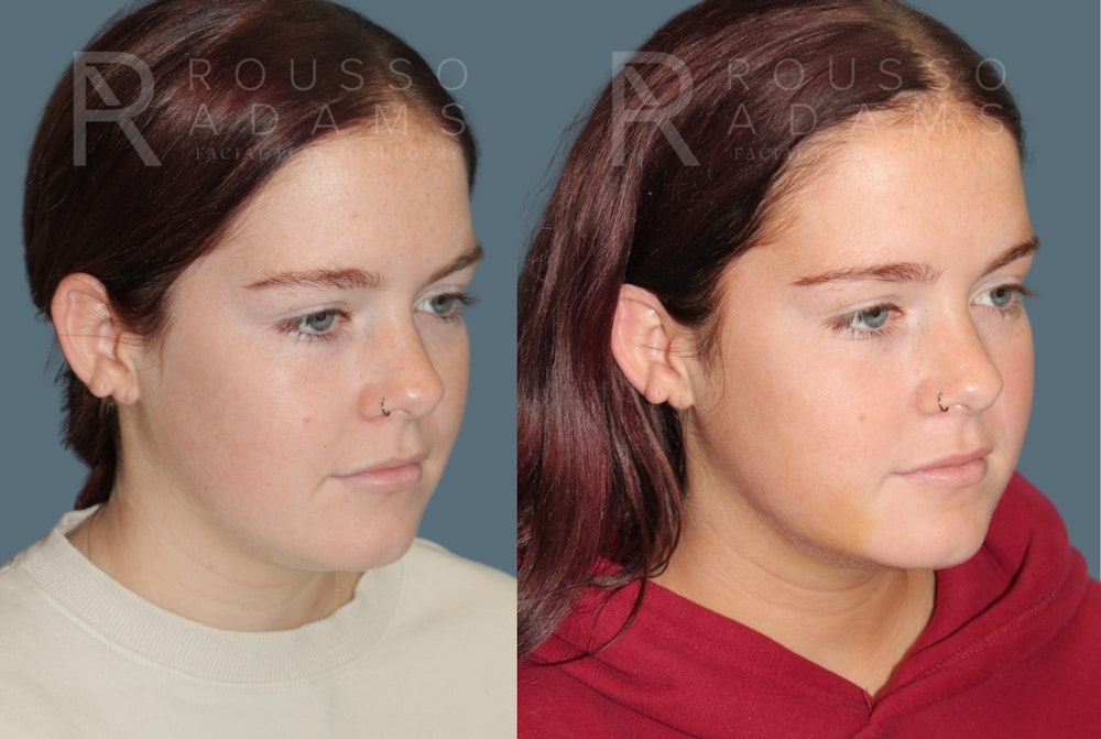 Acculift <span class=small>By Dr. Daniel Rousso</span> Before & After Gallery - Patient 336954 - Image 1