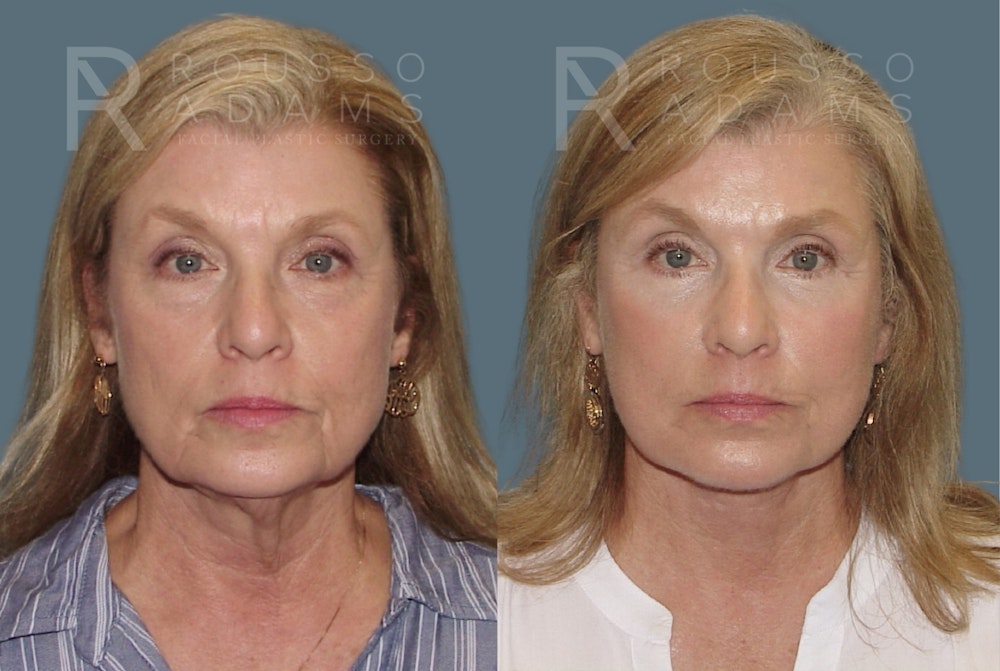 SculptLift™ <span class=small>By Dr. Daniel Rousso</span> Before & After Gallery - Patient 150207 - Image 3