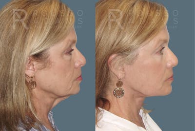 SculptLift™ <span class=small>By Dr. Daniel Rousso</span> Before & After Gallery - Patient 150207 - Image 2