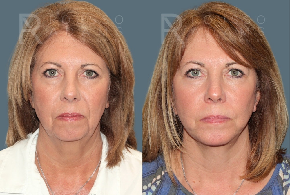 Facelift <span class=small>By Dr. Daniel Rousso</span> Before & After Gallery - Patient 260482 - Image 3