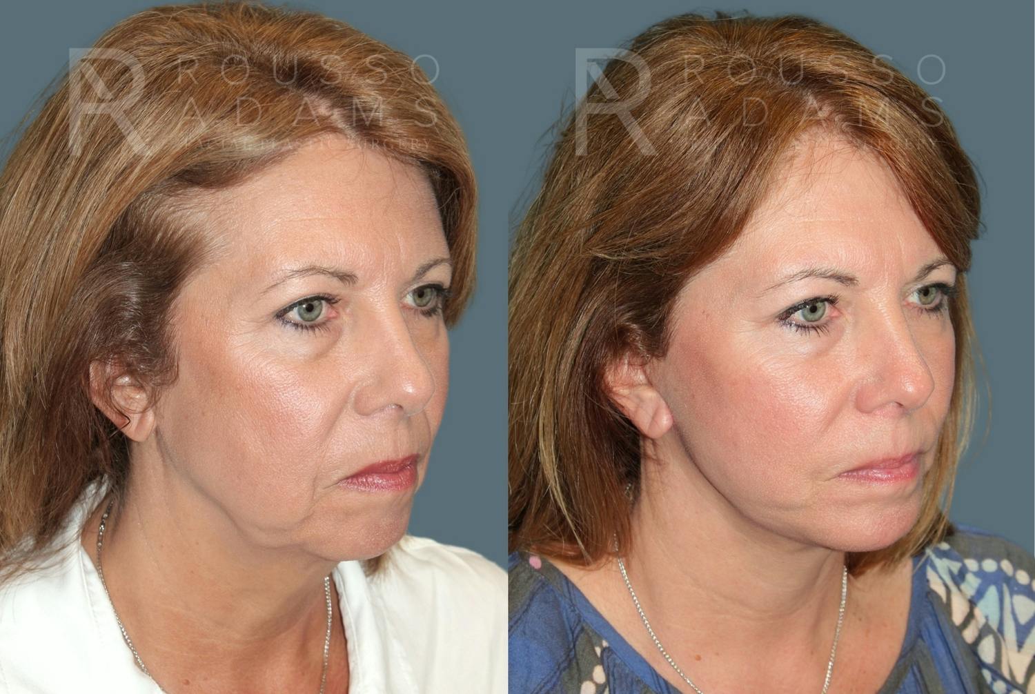 Before & After Image