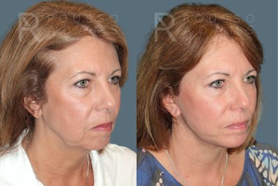 Facelift <span class=small>By Dr. Daniel Rousso</span> Before & After Gallery - Patient 260482 - Image 1