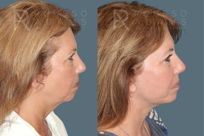 Facelift <span class=small>By Dr. Daniel Rousso</span> Before & After Gallery - Patient 260482 - Image 2