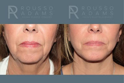 Facelift <span class=small>By Dr. Daniel Rousso</span> Before & After Gallery - Patient 260482 - Image 4