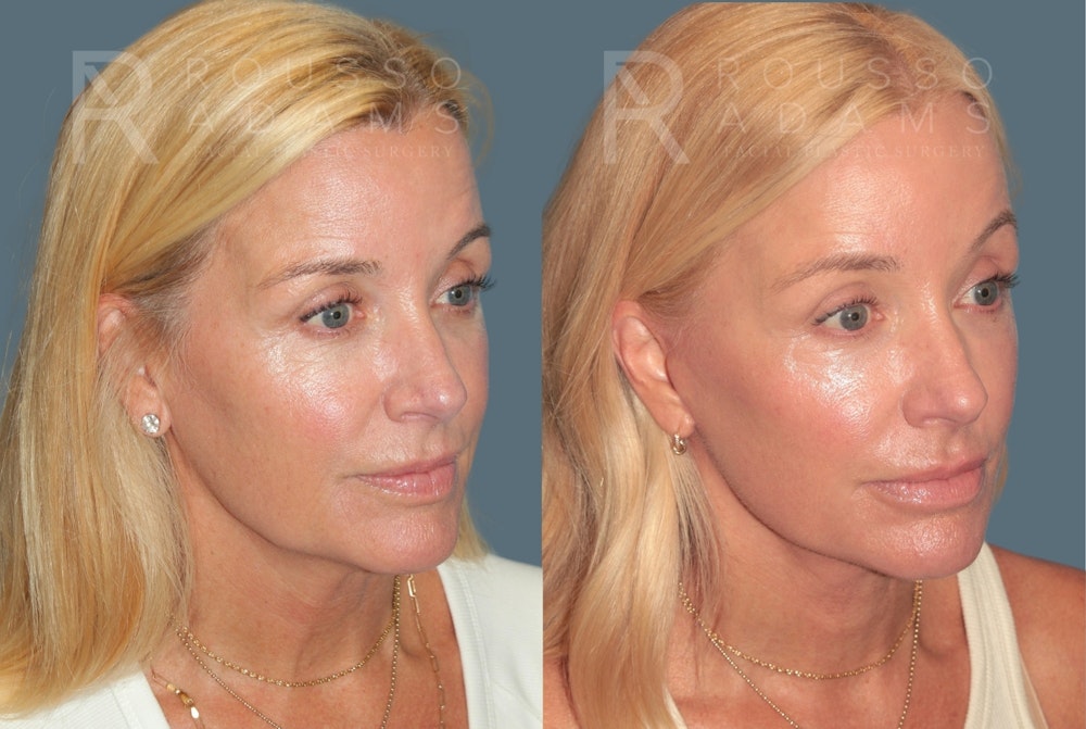 Deep Plane Facelift <span class=small>By Dr. Daniel Rousso</span> Before & After Gallery - Patient 773050 - Image 1