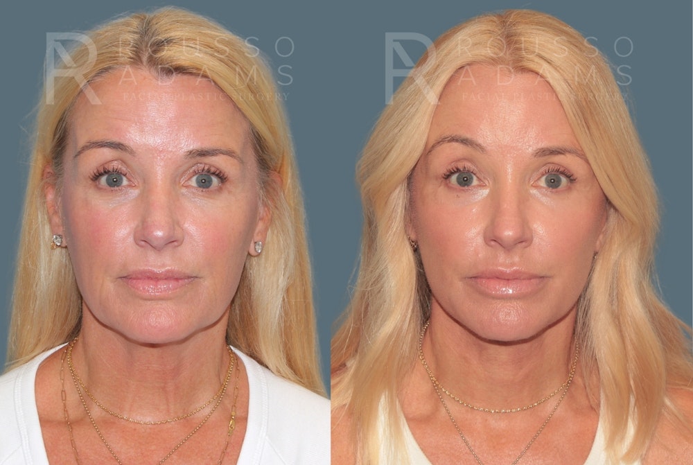 Deep Plane Facelift <span class=small>By Dr. Daniel Rousso</span> Before & After Gallery - Patient 773050 - Image 3