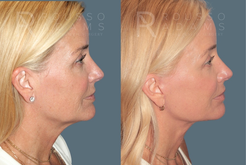 Deep Plane Facelift <span class=small>By Dr. Daniel Rousso</span> Before & After Gallery - Patient 773050 - Image 2