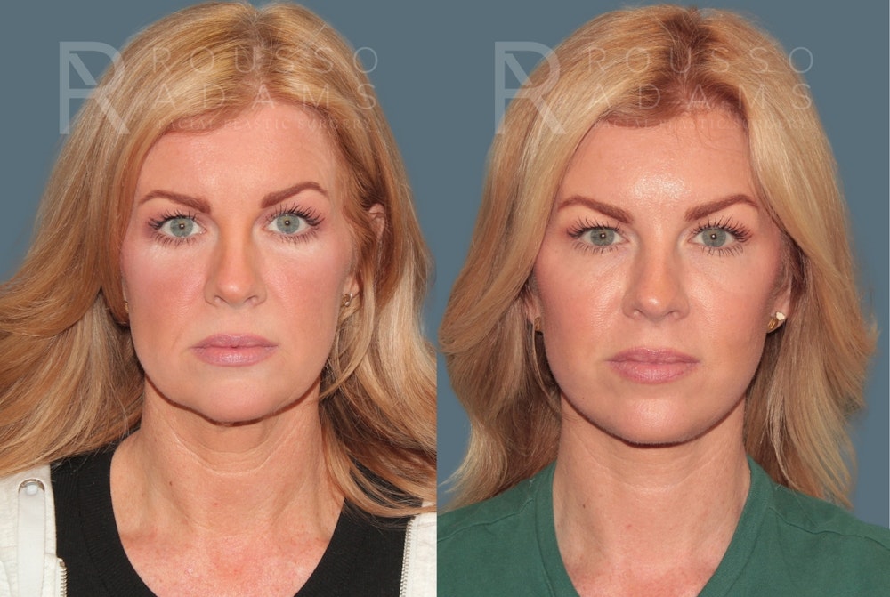 Deep Plane Facelift <span class=small>By Dr. Daniel Rousso</span> Before & After Gallery - Patient 278334 - Image 3