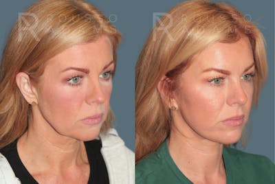 Deep Plane Facelift <span class=small>By Dr. Daniel Rousso</span> Before & After Gallery - Patient 278334 - Image 2